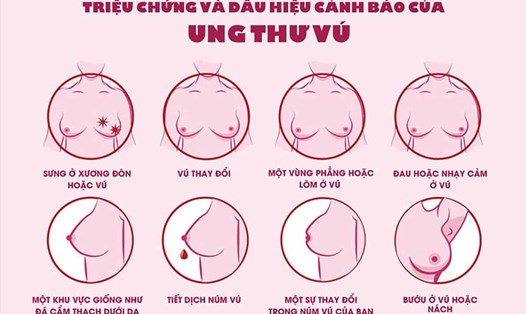 Các triệu chứng của ung thư vú. Nguồn ảnh: Bệnh viện K
