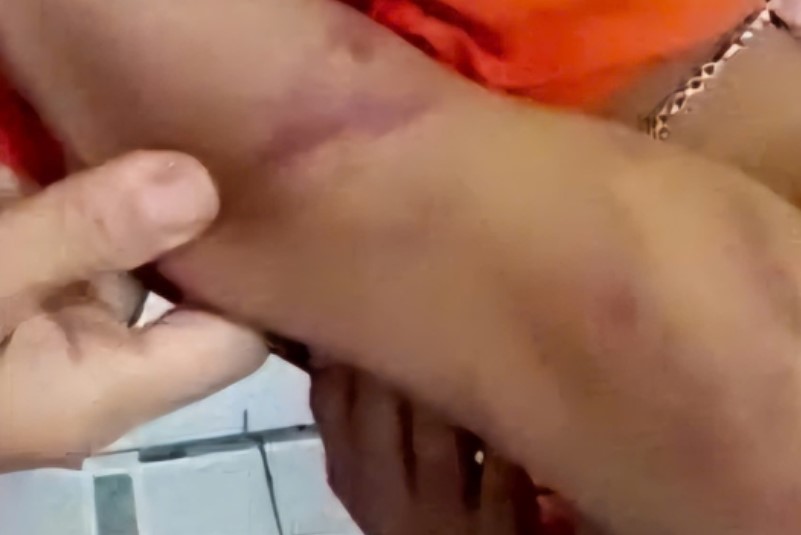 Quảng Nam đã xử phạt nhiều trường hợp bạo hành trẻ em. Trong ảnh: Một học sinh lớp 7 ở TP.Tam Kỳ bị cha ruột bạo hành vào năm 2021. Ảnh: Hoàng Bin