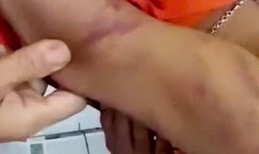 Quảng Nam đã xử phạt nhiều trường hợp bạo hành trẻ em. Trong ảnh: Một học sinh lớp 7 ở TP.Tam Kỳ bị cha ruột bạo hành vào năm 2021. Ảnh: Hoàng Bin