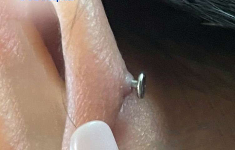 Swollen earlobe after cartilage piercing. Photo: Provided by Tam Anh General Hospital, Ho Chi Minh City