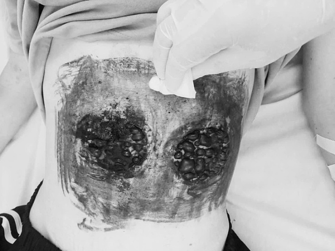 Image of damage after using octagon to treat cancer at home. Photo: Provided by doctor