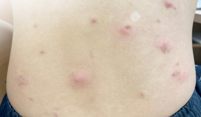 Parasites (hookworm larvae) move on a patient's back, causing itching and discomfort. Photo: Provided by the hospital