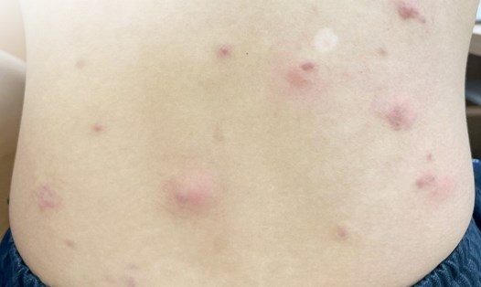 Ký sinh trùng (ấu trùng giun móc) di chuyển trên lưng một người bệnh gây ngứa ngáy, khó chịu. Ảnh: Bệnh viện cung cấp