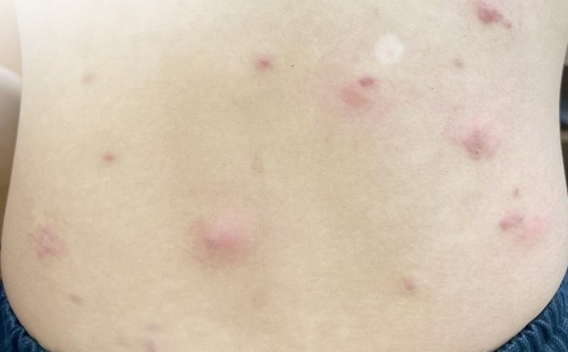 Parasites (hookworm larvae) move on a patient's back, causing itching and discomfort. Photo: Provided by the hospital