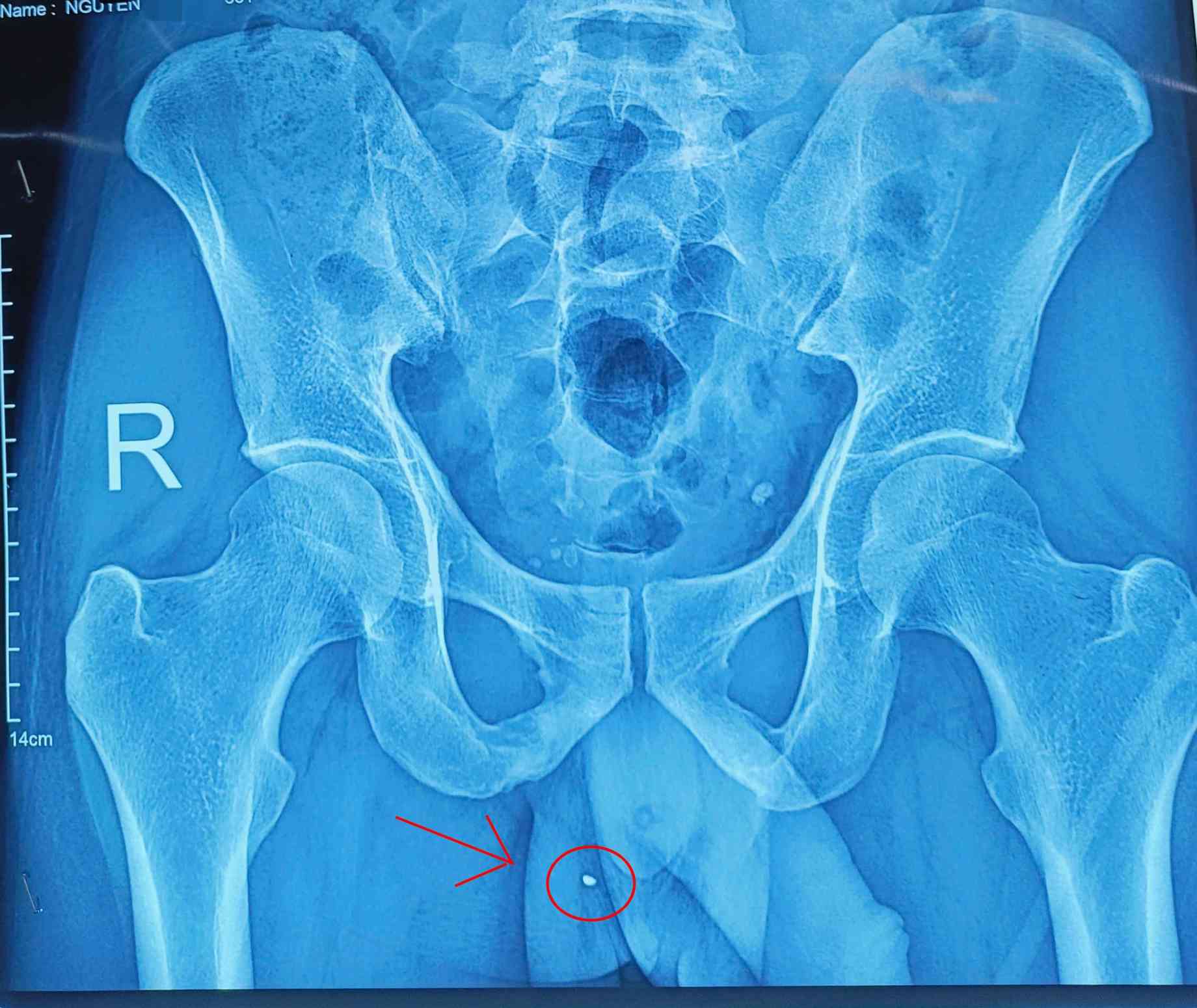 Hình ảnh dị vật xuyên vùng kín. Ảnh: BVCC