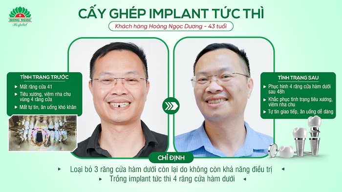 Ket qua cay ghep implant tuc thi cho khach hang Hoang Ngoc Duong (43 tuoi). Anh: RHM Hong Ngoc 