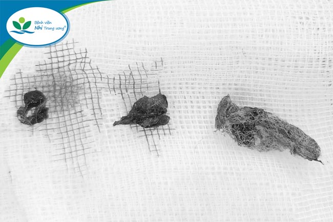 Foreign objects are pieces of cotton removed from the girl's vagina. Photo: BVCC