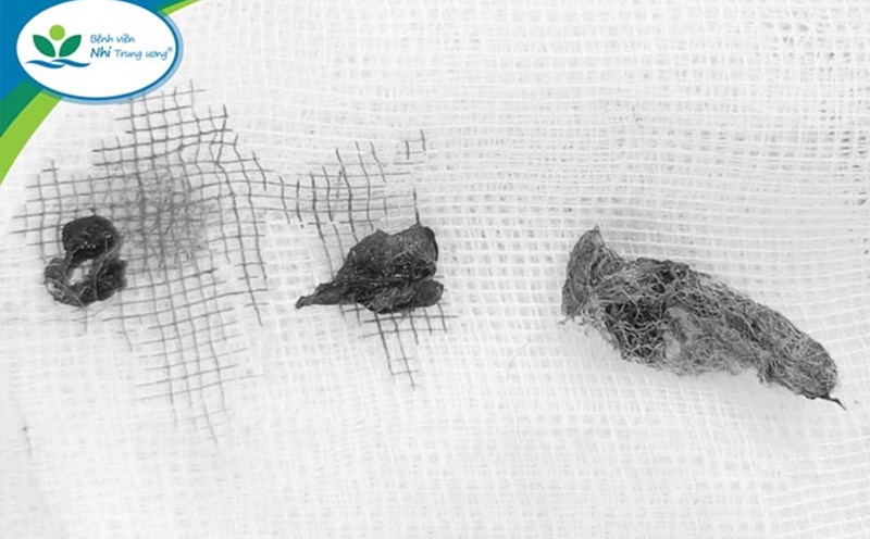 Foreign objects are pieces of cotton removed from the girl's vagina. Photo: BVCC
