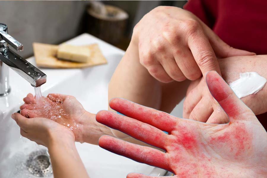 Washing your hands too often can cause rashes. Graphics: Thien Nhan