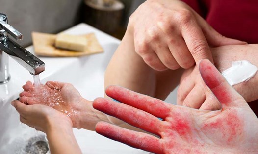 Rửa tay quá thường xuyên có thể gây phát ban. Đồ hoạ: Thiện Nhân