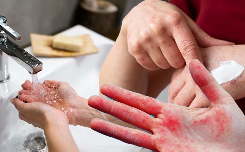 Washing your hands too often can cause rashes. Graphics: Thien Nhan