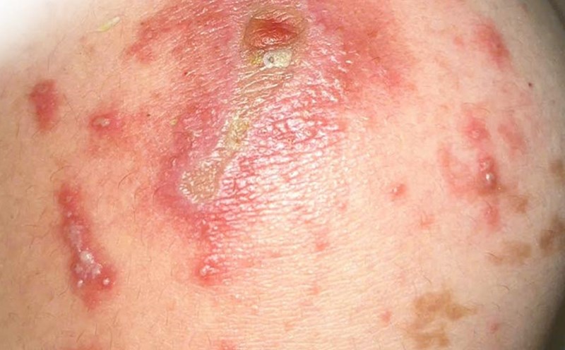 Typical lesions of dermatitis caused by ants on the patient's shoulder. Photo: Provided by the hospital