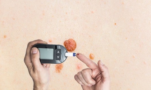 Một số dấu hiệu trên da cho thấy đường huyết tăng vọt. Đồ họa: Hạ Mây