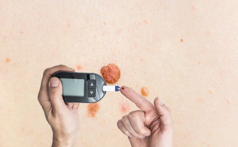 Some signs on the skin show a spike in blood sugar. Graphics: Ha May