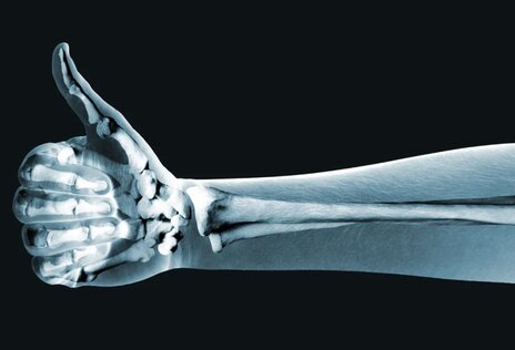 You can completely prevent or slow down the aging process of bones with healthy eating habits. Photo: According to Eatthisnotthat