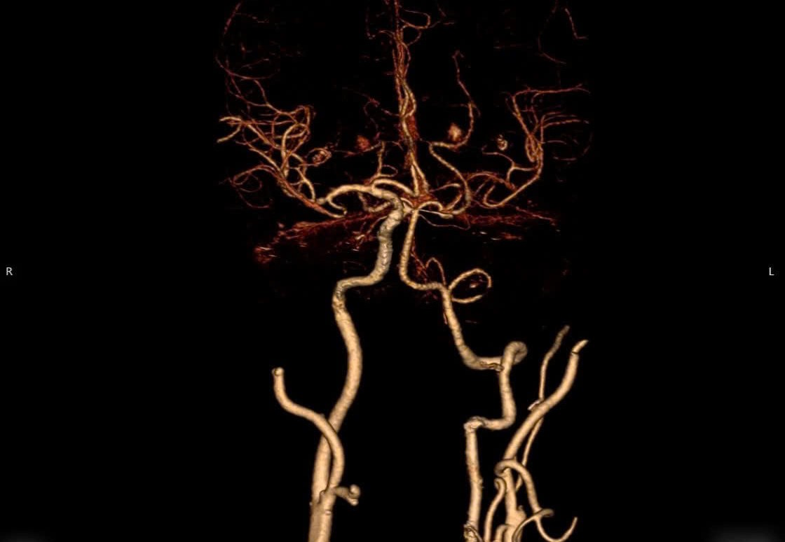 Saving patients with right hemiparesis, 7th hour stroke. Photo: BVCC