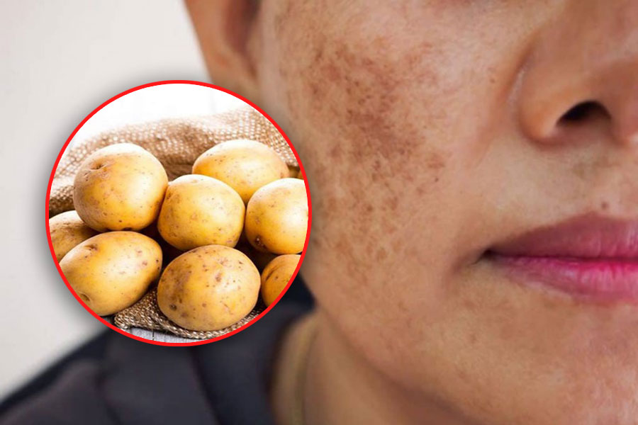 4 effective ways to treat melasma with potatoes. Graphics: Tuan Anh.