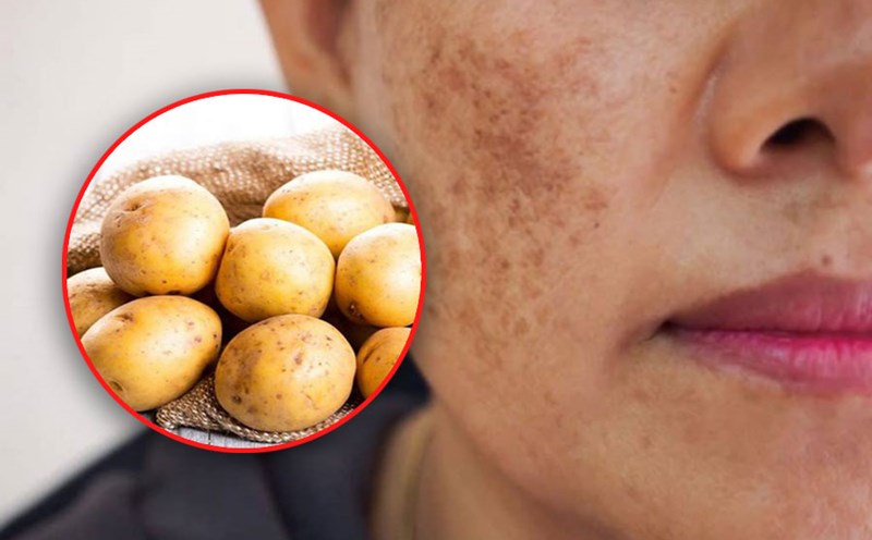 4 effective ways to treat melasma with potatoes. Graphics: Tuan Anh.