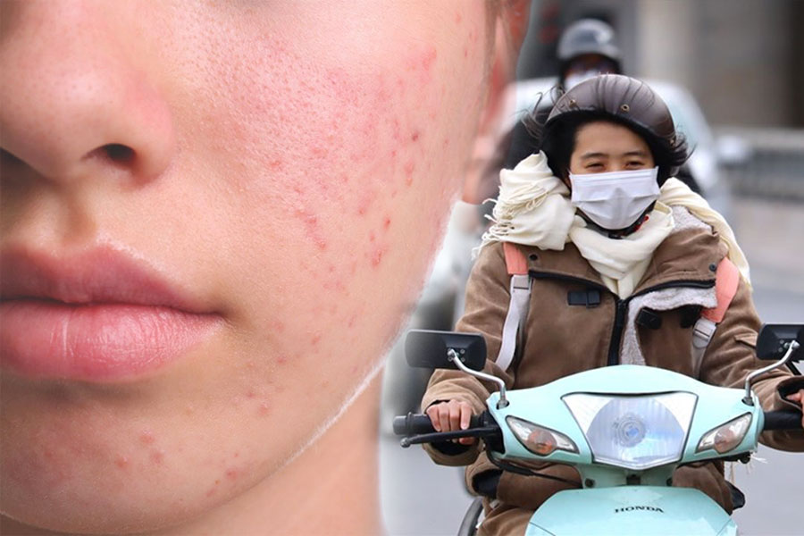 How to overcome skin hyperpigmentation in winter. Graphics: Tuan Anh.