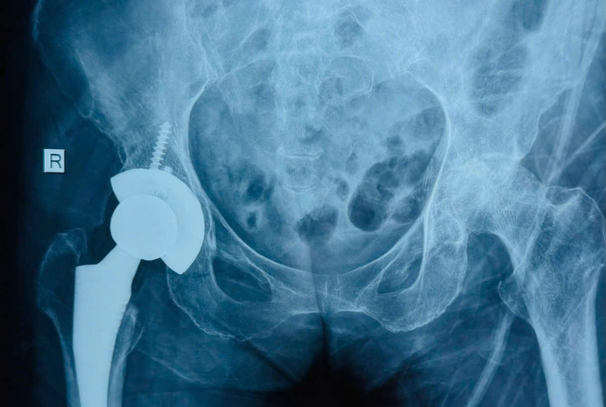 Rehabilitation of movement for patients with femoral head necrosis. Photo: Provided by the hospital