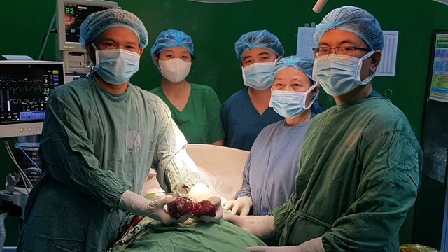Doctors have just successfully removed a large thyroid goiter from a 24-year-old female patient. Photo: Da Nang Hospital