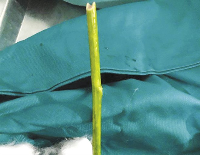 Nhiều người tự phá thai tại nhà bằng nhiều cách khác nhau, gây nguy hiểm đến tính mạng. Ảnh minh hoạ: Bệnh viện Đa khoa tỉnh Tuyên Quang