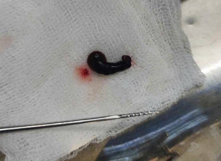 A leech about 4cm long was removed from the female patient's nose. Photo: Bac Quang Binh General Hospital