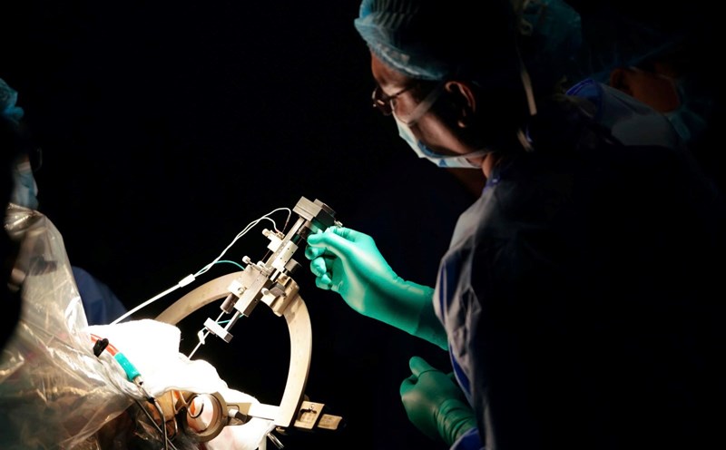 Surgery to treat epilepsy, save lives