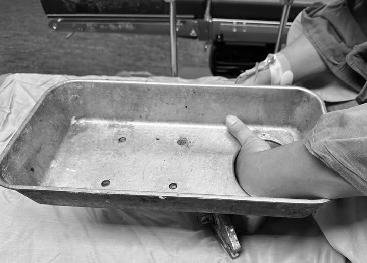 Man hospitalized with hand still in meat grinder. Photo: BVCC