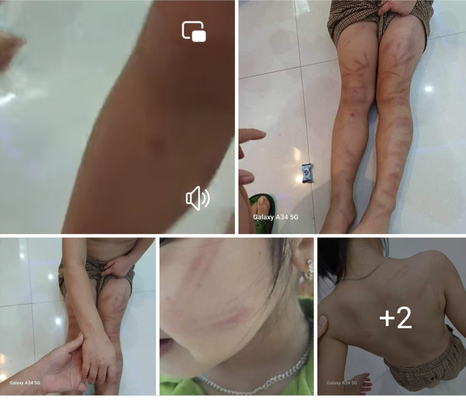 Phụ huynh hoảng hốt khi phát hiện các vệt bầm tím trên cơ thể con. Ảnh: Hải Đăng