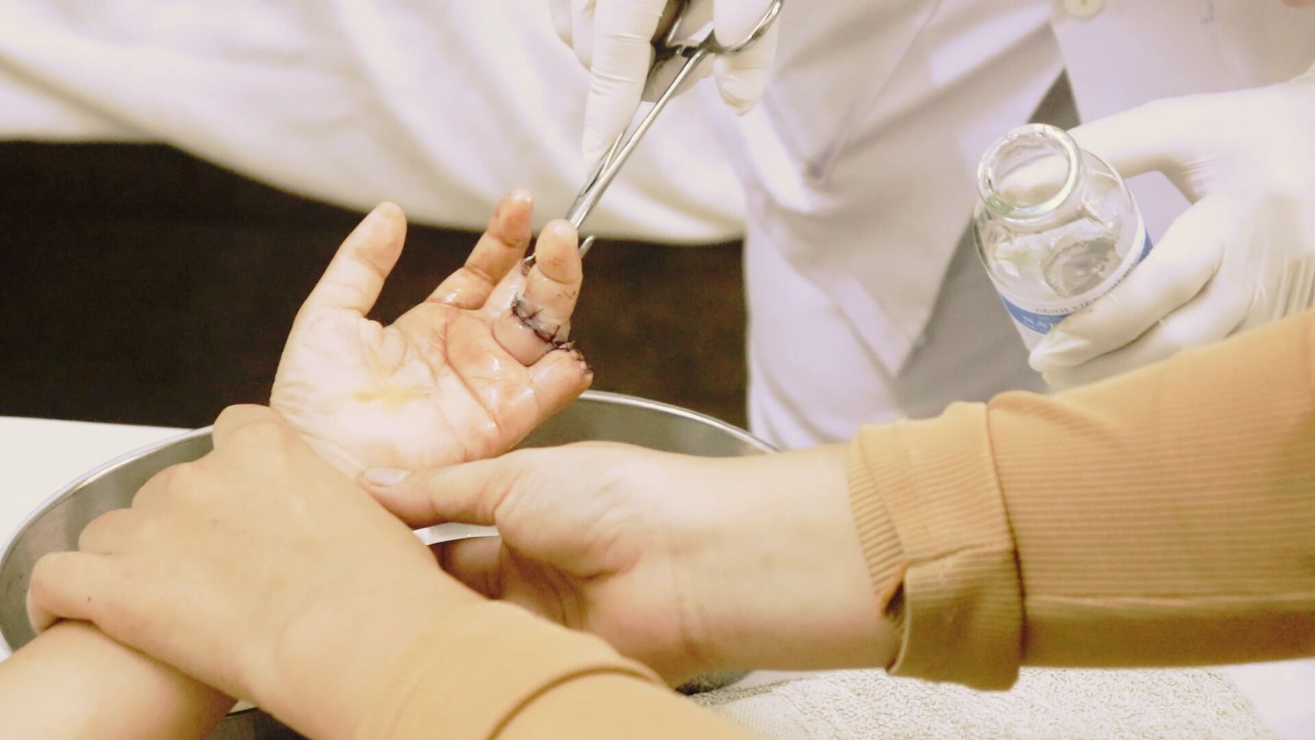 Bệnh nhi đứt lìa ngón tay được bác sĩ cấp cứu. Ảnh: MINH TÂM 