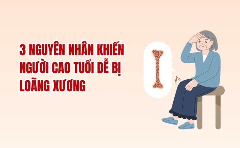 3 reasons why the elderly are susceptible to osteoporosis