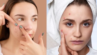 What you're eating could be inadvertently irritating and making your acne worse.