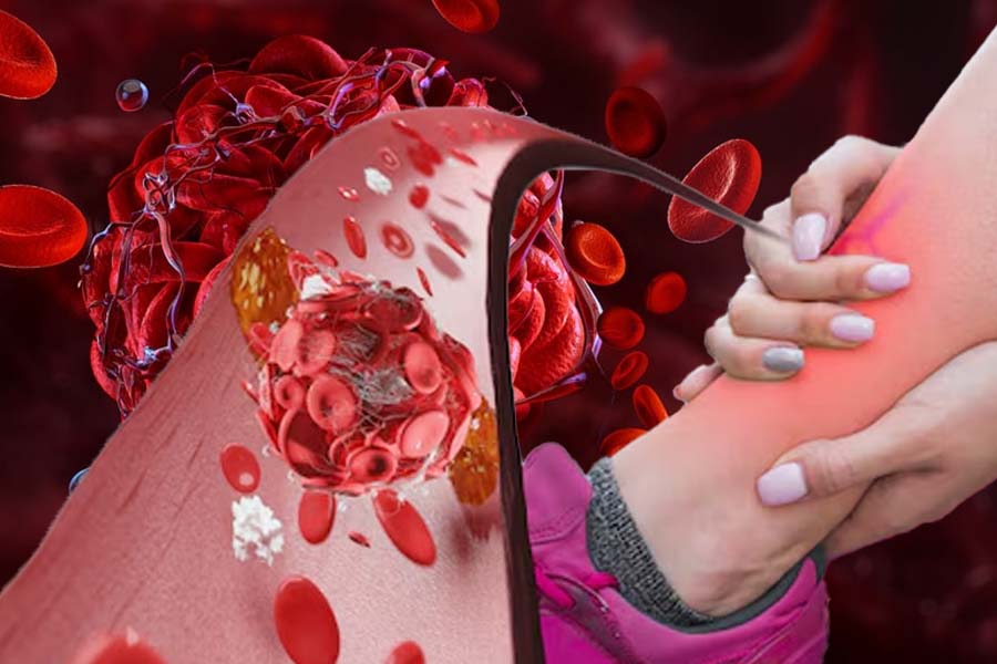 Thrombosis is a condition that causes blood clots in the blood vessels, which can lead to swelling in the legs, heart attack or stroke. Graphics: Thien Nhan