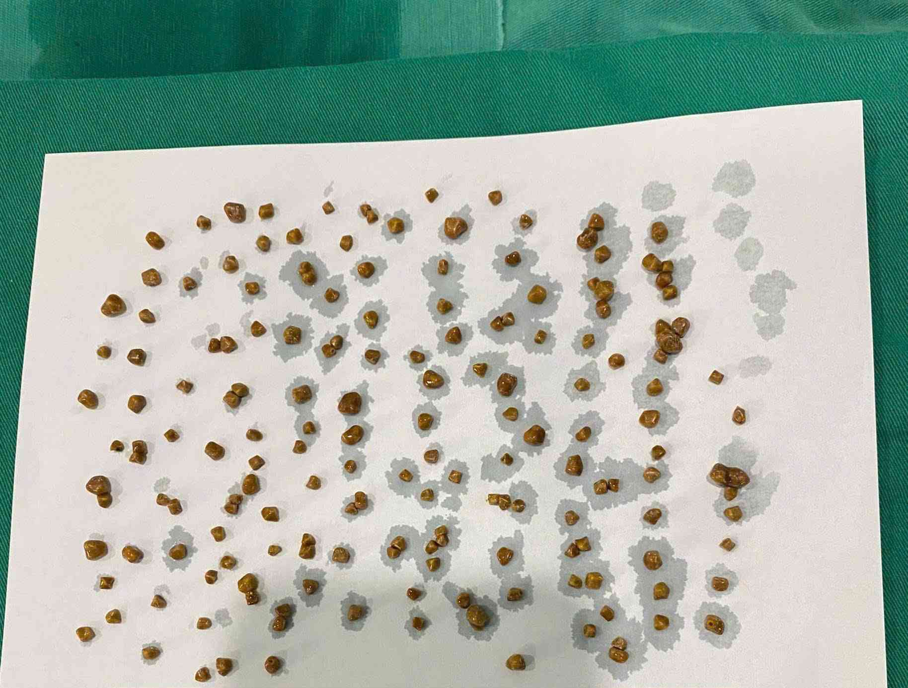 172 stones were removed from the patient's gallbladder. Photo: BVCC