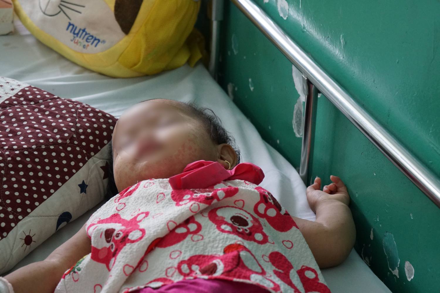 Children hospitalized for measles treatment. Photo: Thanh Chan