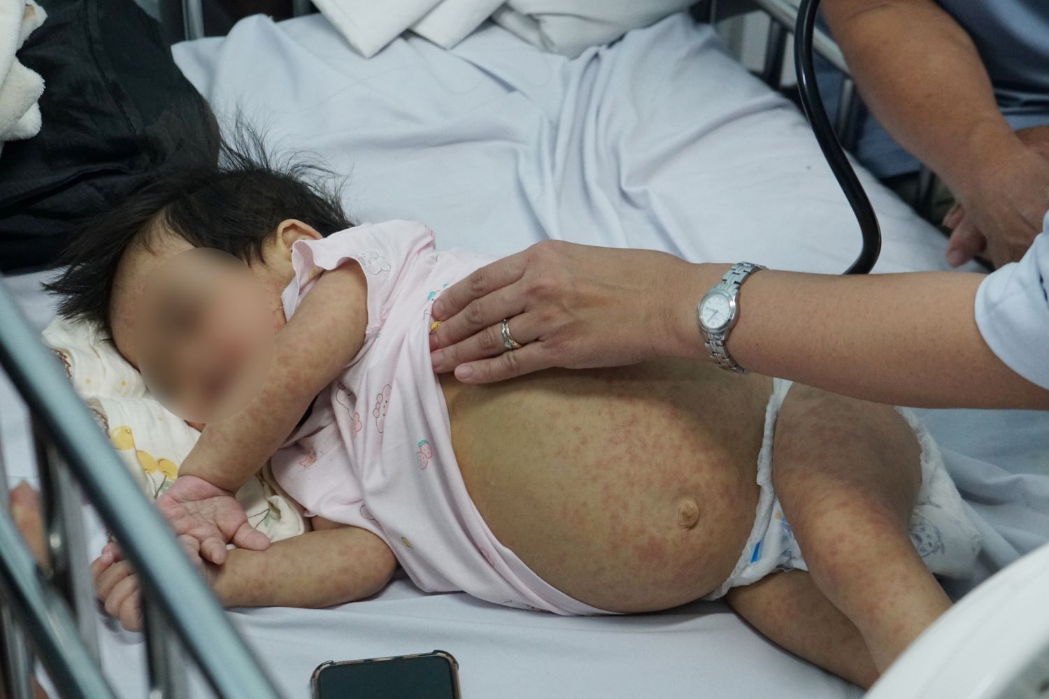 Increasing number of measles cases in Ho Chi Minh City. Photo: Thanh Chan
