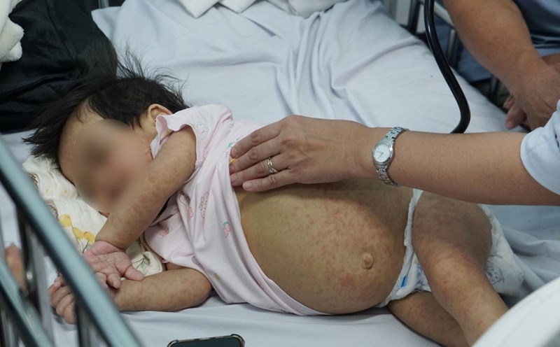Increasing number of measles cases in Ho Chi Minh City. Photo: Thanh Chan