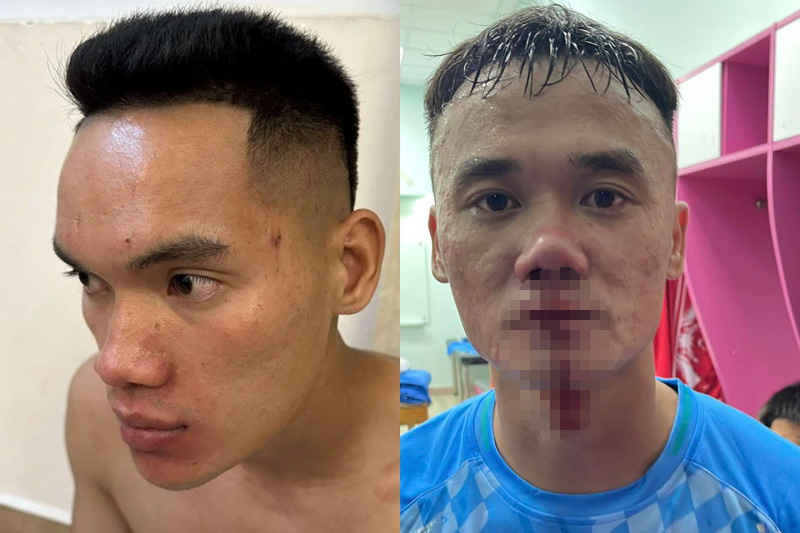 Image of Vu Van Son (left) and Nguyen Xuan Nam (right) after the fight. Photo: Interviewee/PVF-CAND