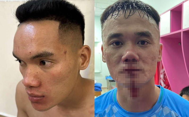 Image of Vu Van Son (left) and Nguyen Xuan Nam (right) after the fight. Photo: Interviewee/PVF-CAND
