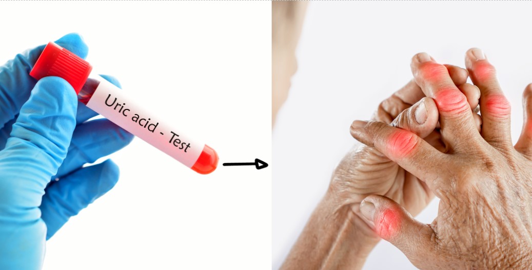 How to reduce uric acid naturally. Graphics: Cao Thom
