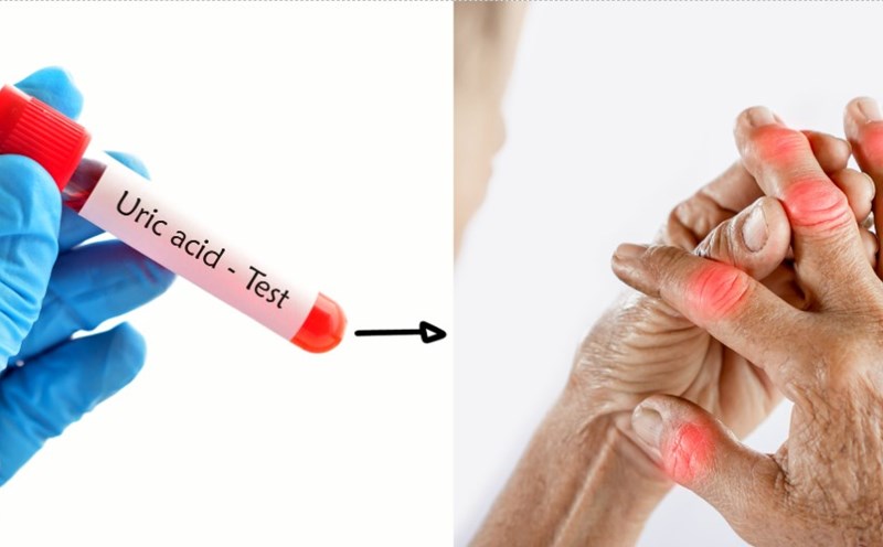 How to reduce uric acid naturally. Graphics: Cao Thom