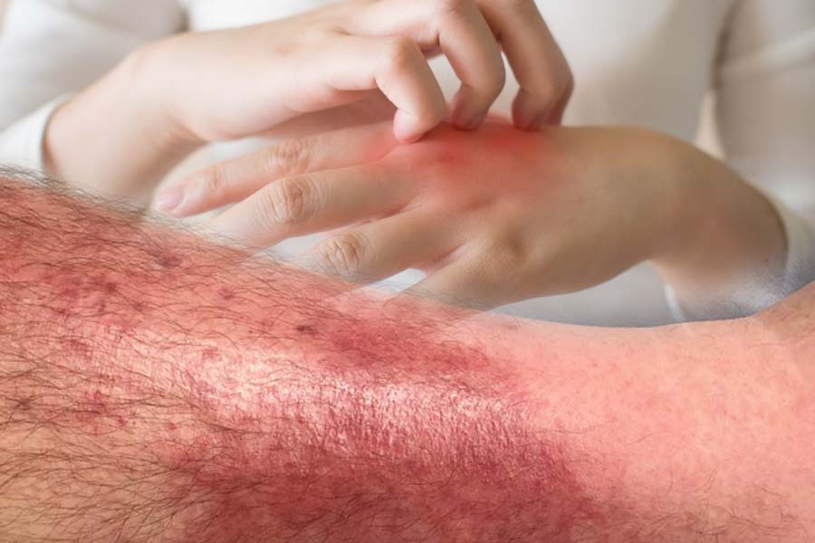 Complications of cellulitis. Graphics: Thien Nhan