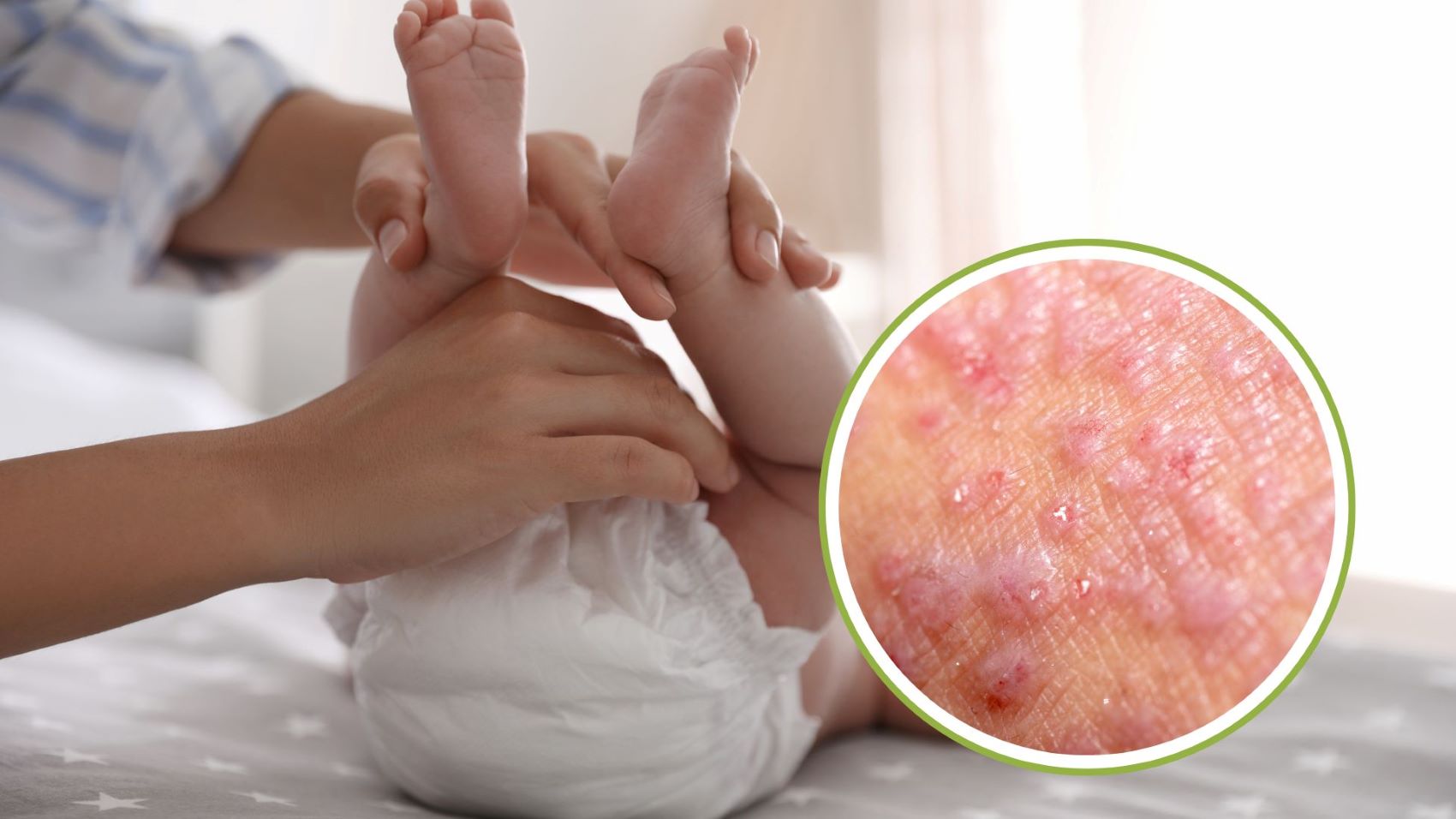 Diaper dermatitis is one of the common diseases in infants. Graphics: Thanh Thanh