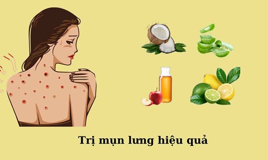 Những sản phẩm dễ kiếm trị mụn lưng hiệu quả. Đồ họa: Khánh Linh