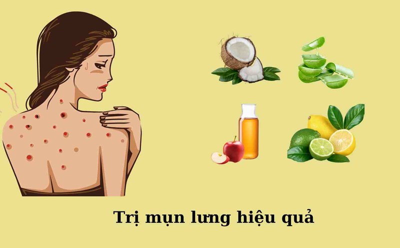 Easy-to-find products that effectively treat back acne. Graphics: Khanh Linh