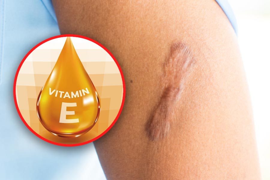 Secret to effectively treating scars with vitamin E at home. Graphics: Tuan Anh.