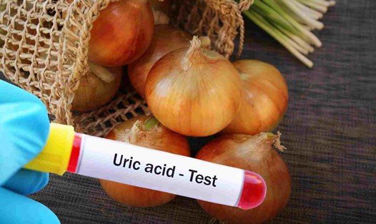 Cách chế biến hành tây giúp hạn chế axit uric tăng vọt