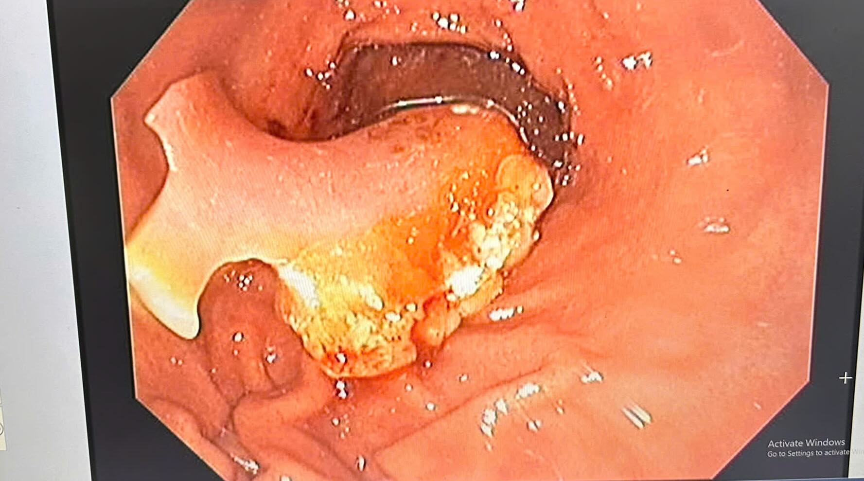 A woman in Quang Binh swallowed her dentures while taking medicine. Photo: Dong Hoi General Hospital.