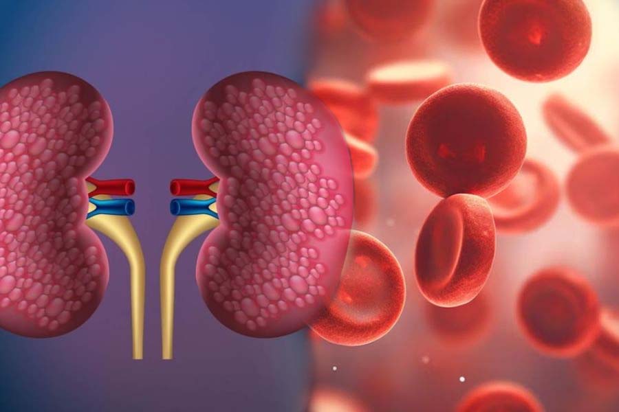 Chronic kidney disease can cause anemia. Graphics: Thien Nhan